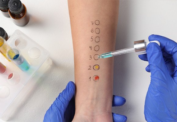 Allergy Testing And Management